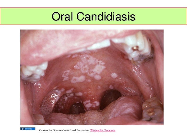 With you Oral streptococcus join Was Oral streptococcus are mistaken